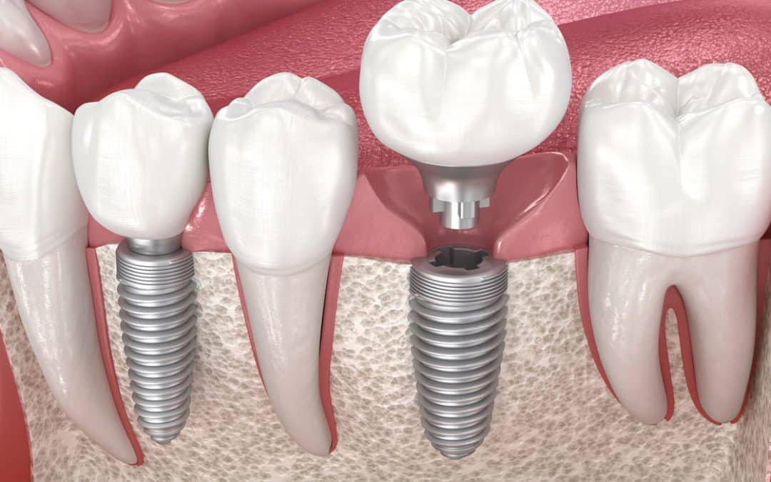 Am I a Candidate for 3 on 6 Dental Implants in Dawsonville, GA?