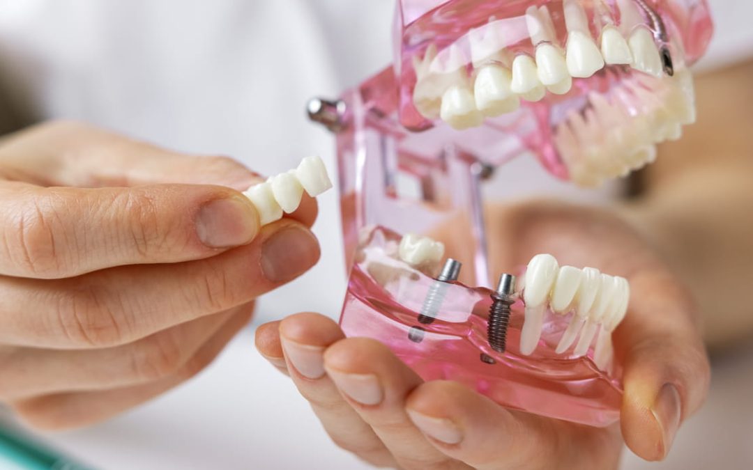 What Are Dental Implants and How Do They Compare to Other Tooth Replacement Options?