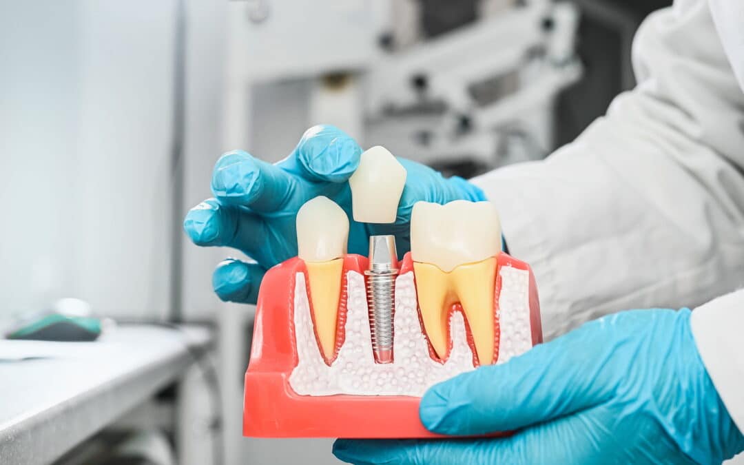 Do I Need Bone Grafting Before Dental Implants?